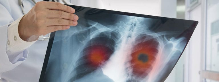 Lung Autopsy Services in Los Angeles County | 1-800-Autopsy